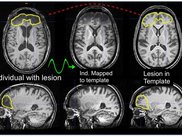 Lesion estimation in template space.