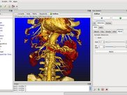 Volume rendering of abdominal CTA