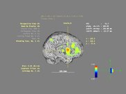 T-map overlaid on a cortical  segmentation (+AAL label)