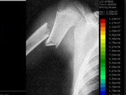 Analisis de fractura del humero