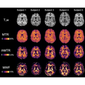 Adult MRI ihMTR, MWF, angle brain atlas