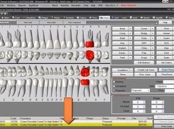 AceDental-Crown-Chart