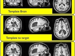 A successful large deformation brain normalization with ANTS