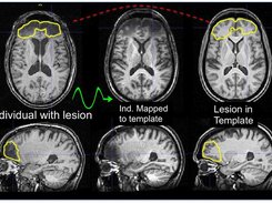 Lesion estimation in template space.