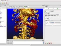 Volume rendering of abdominal CTA