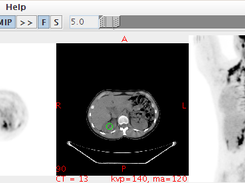 MIP image