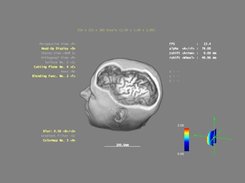 Cutting planes in arbitrary orientations (MRI scan)