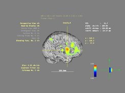 T-map overlaid on a cortical  segmentation (+AAL label)