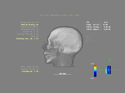 CT Scan with semi-translucency added (alpha blending)