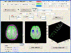 BRIC1936: example showing results of segmentation of white matter hyperintensities