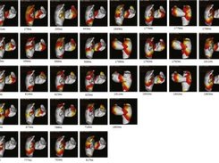 isochronal map in atrial fibrillation
