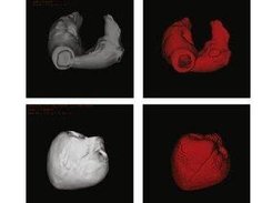 partition on the anatomic data