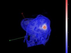 3-D orthogonal view of the superposition result on a patient