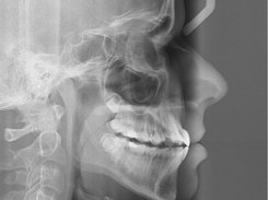 Cervical Vertebral Maturation