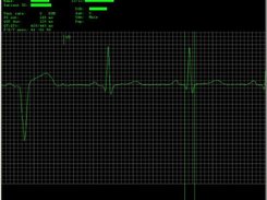 The ECG Viewer with Caliper