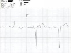 The ECG Viewer with Caliper (2)