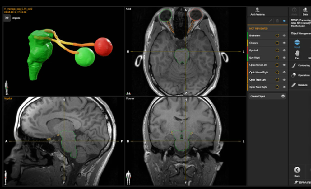 Elements Multiple Brain Mets SRS Screenshot 1