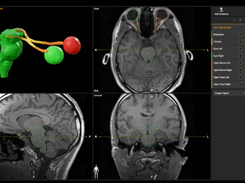 Elements Multiple Brain Mets SRS Screenshot 1