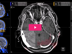 Elements Multiple Brain Mets SRS Screenshot 1