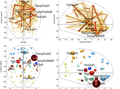 split edge strength / degree spheres fMRI clinical diagnosis task, showing discriminative weights of regions and connections (PubMed PMID 22677149)