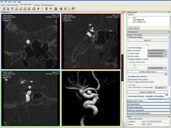 Vessel segmentation