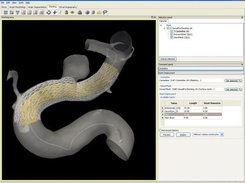 Stenting