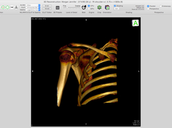 3D Reconstruction in Horos