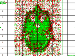 First Test Positive MRI (red clusters show cancer)