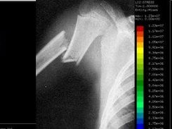 Analisis de fractura del humero