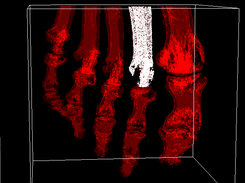 Pie humano con hueso mallado