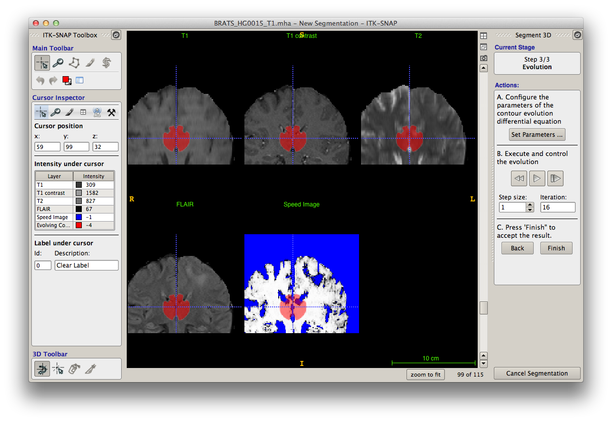Itk Snap Medical Image Segmentation Tool Download Sourceforge Net