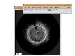 LiveWire ImageJ plugin during an IVUS segmentation