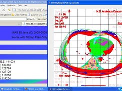 MRI Analysis Result of Cancer Detection (Fine Grain)