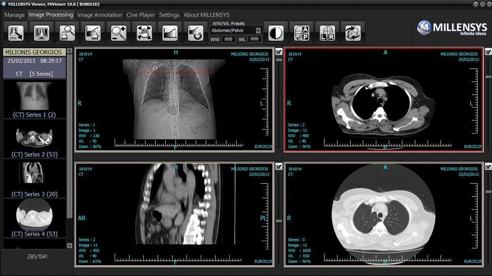 CT case Viewing with MILLENSYS DICOM VIEWER , MiViewer