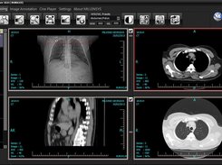 CT case Viewing with MILLENSYS DICOM VIEWER , MiViewer