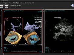 ultrasound case Viewing with MILLENSYS DICOM VIEWER , MiViewer