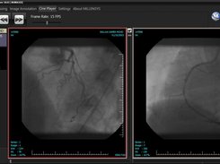 Cardiac Cathlab case Viewing with MILLENSYS DICOM VIEWER , MiViewer