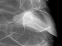 Mammogram