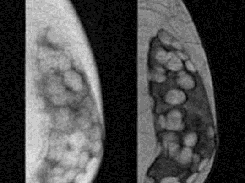 MRI
