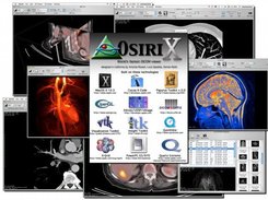 OsiriX