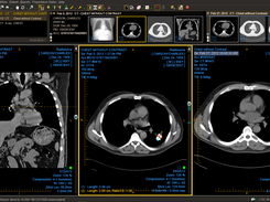 Chest CT with prior study comparison