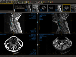 Cervical spine MR showing spine labeling