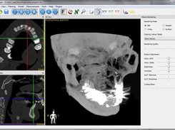 Maxima intensity projection