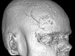 Head, Iso Surface from MR volume data